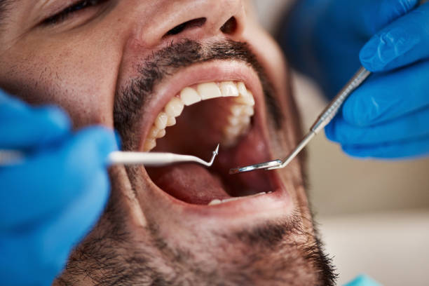 Best Emergency Tooth Extraction in Springdale, AR